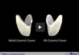 Metal-Ceramic vs<br></noscript>All-Ceramic Crown