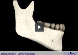Bone Atrophy -<br></noscript>Lower Mandible