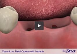 Ceramic vs Metal <br></noscript>Crowns with Implants