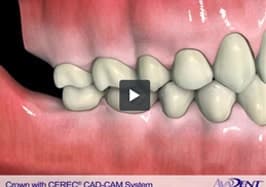 Crown with CEREC®<br></noscript><img class=